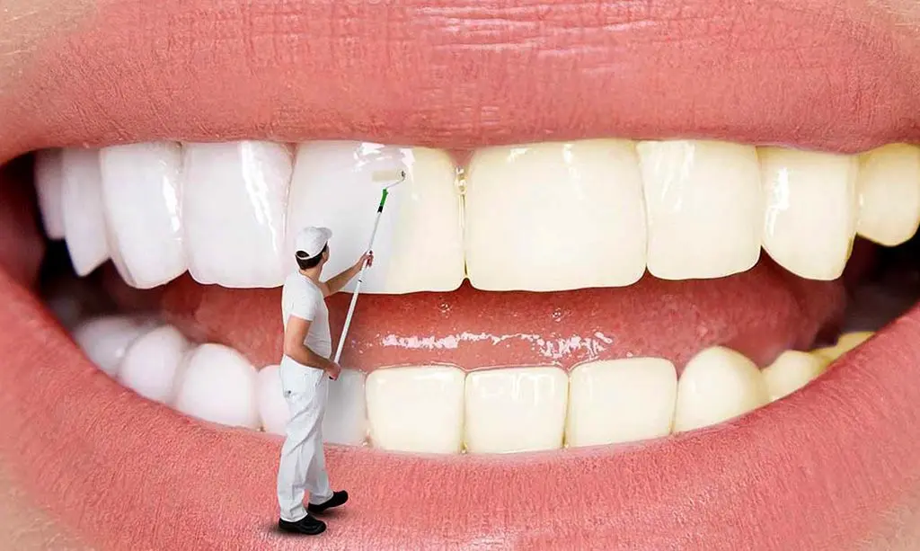 بلیچینگ دندان بهتر است یا کامپوزیت دندان؟