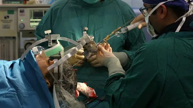 انجام جراحی تومور مغزی در حالت بیدار برای نخستین‌بار در مازندران