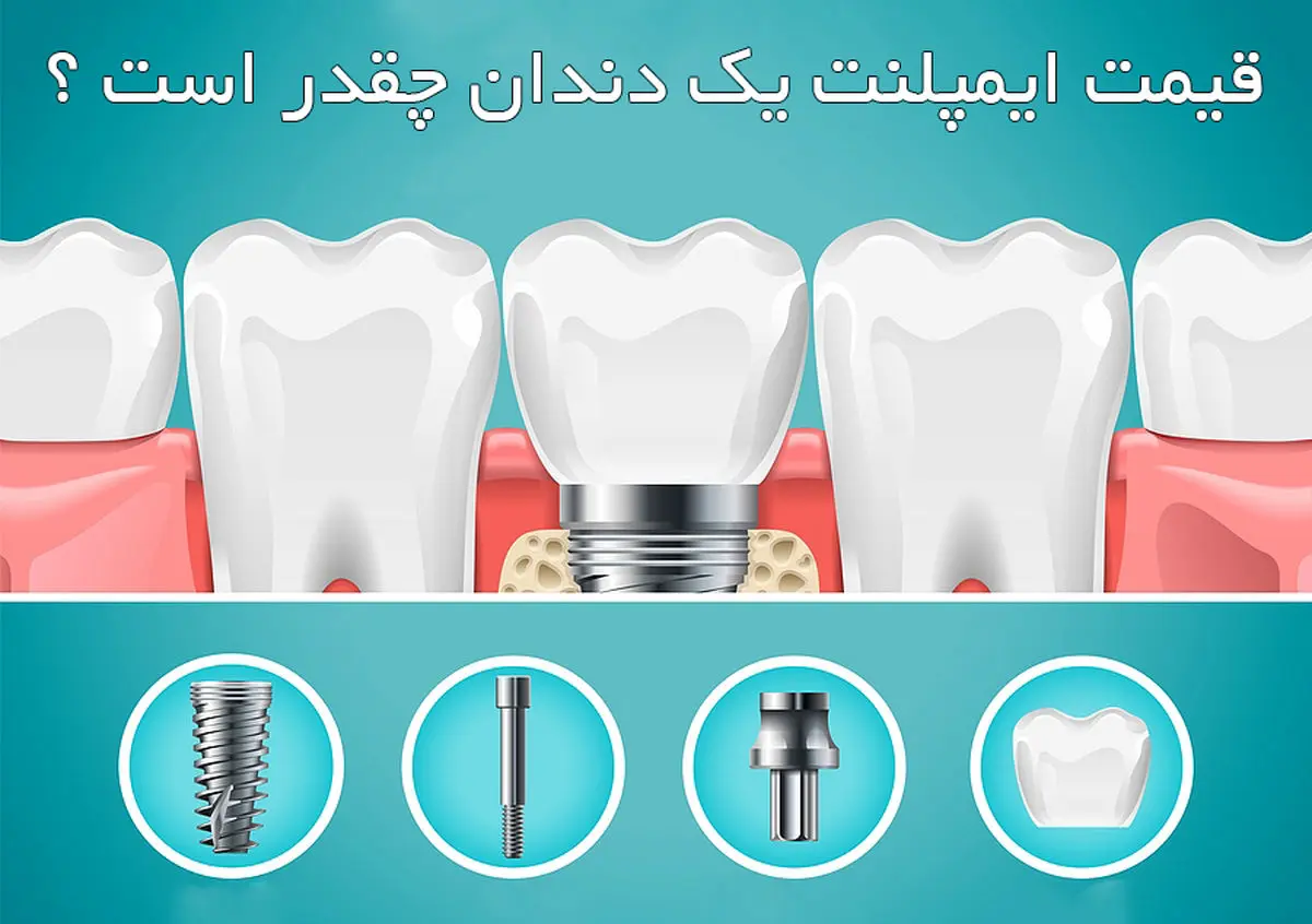 قیمت ایمپلنت یک دندان چقدر است؟