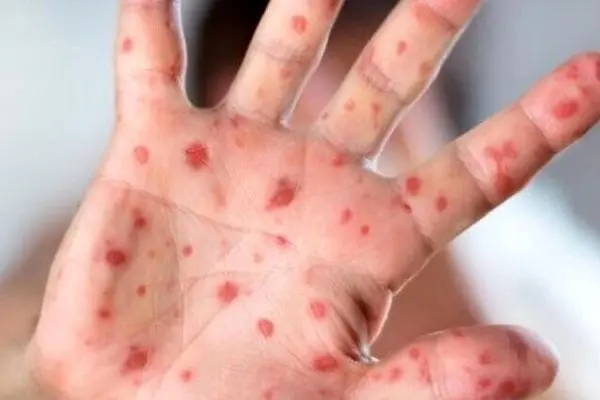 
زنگ خطر شیوع سرخک در یزد؛ سه مورد ابتلا شناسایی شد

