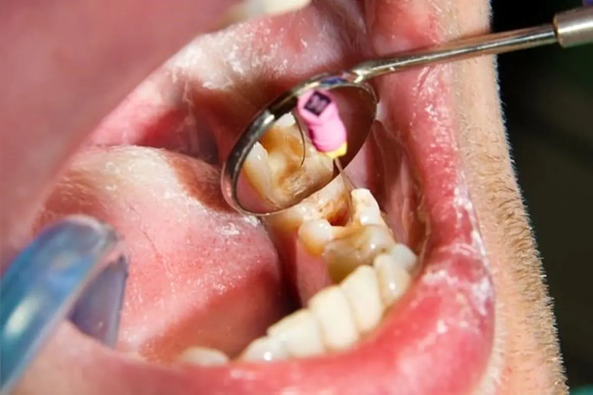 عوارض عصب کشی دندان و راهکارهای بهبود دادن آن